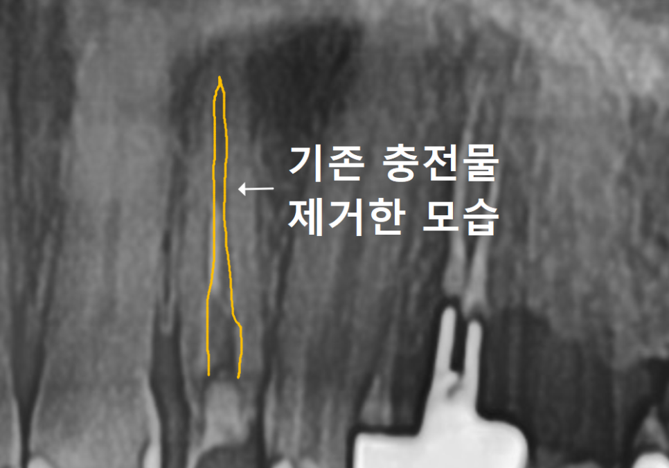 강동구 재신경치료, 왜 첫 치료보다 성공률이 낮다고 할까요? 관련 이미지 8