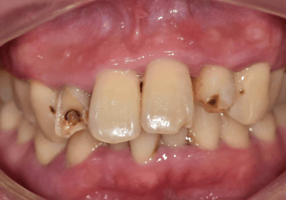강동구 앞니 충치, 누구는 레진이고 누구는 임플란트인 관련 이미지 19