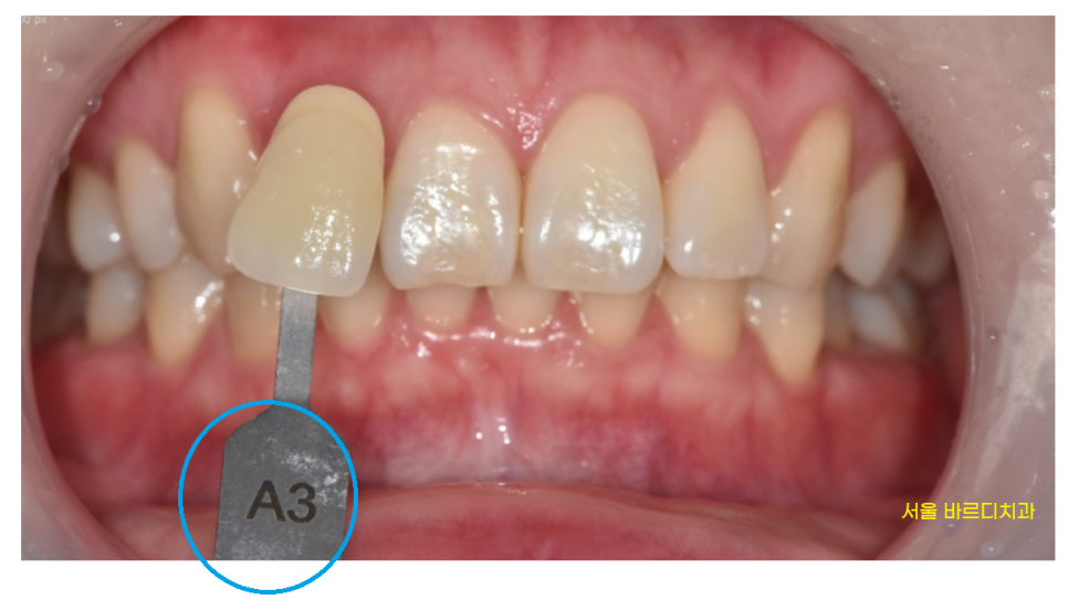 상일동 치아미백 가격, 횟수 궁금하신 부분 싹 정리했습니다. 관련 이미지 3