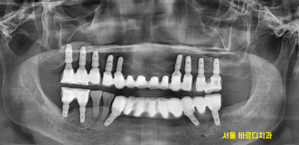 덕소 치과 발치 후 당일 뼈이식의 중요성 설명드립니다!! 관련 이미지 2