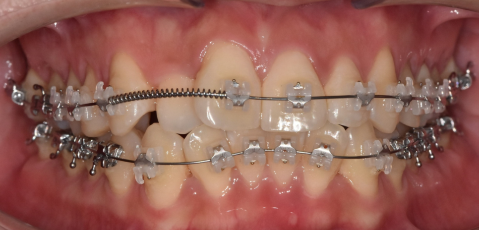 자가결찰 브라켓 빠르게 끝내고 통증은 줄여서 관련 이미지 6