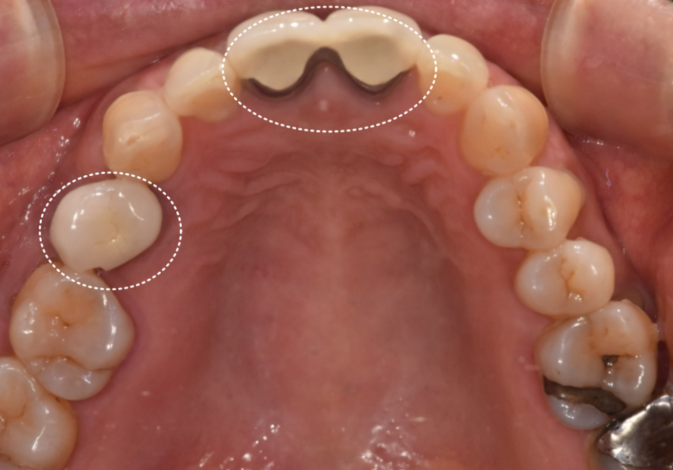 잇몸 까매짐 원인,증상,치료 방법 오래전에 앞니 씌운 곳 잇몸이 까매졌어요. 관련 이미지 5