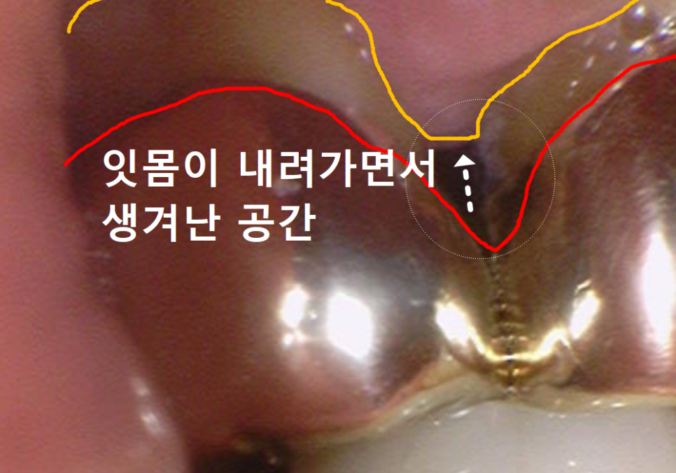 강동구 잇몸 퇴축으로 뿌리 드러난 치아, 이대로 둬도 괜찮을까? 관련 이미지 4
