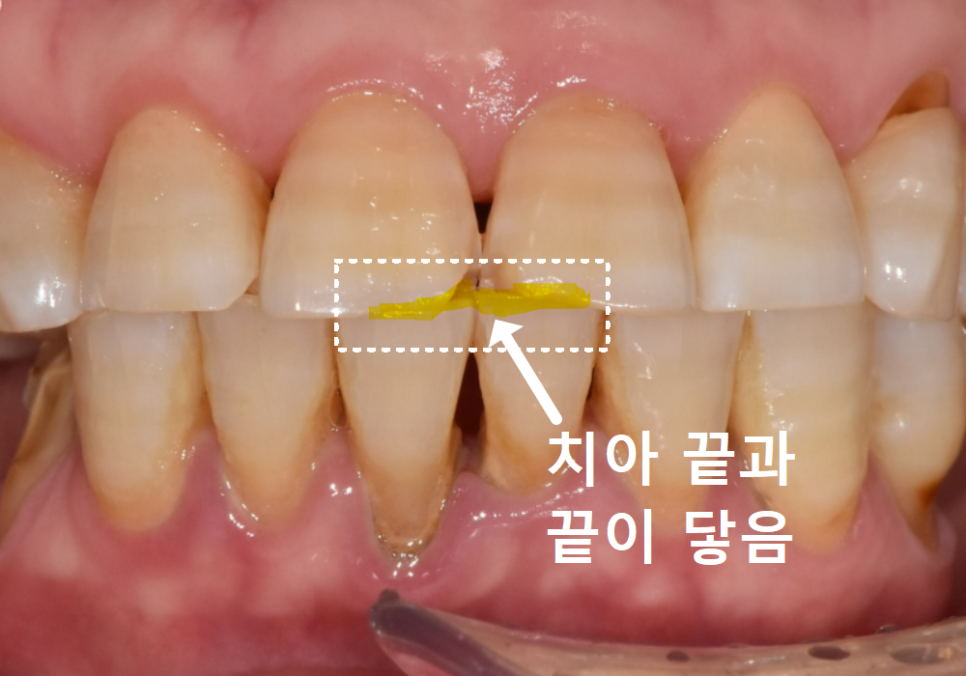 앞니 끝부분 깨짐, 다듬기, 레진, 라미네이트? 어떤 치료가 나에게 적합할까? 관련 이미지 7