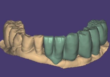 천호 디지털 가이드 임플란트, 일반 임플란트와 무슨 차이가 있나요? 관련 이미지 12
