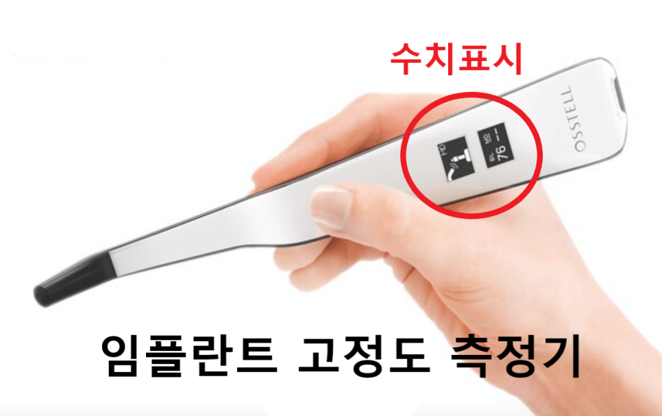 고덕동 20대 임플란트, 시기 놓치면 비용 2배 이상 듭니다. 관련 이미지 10