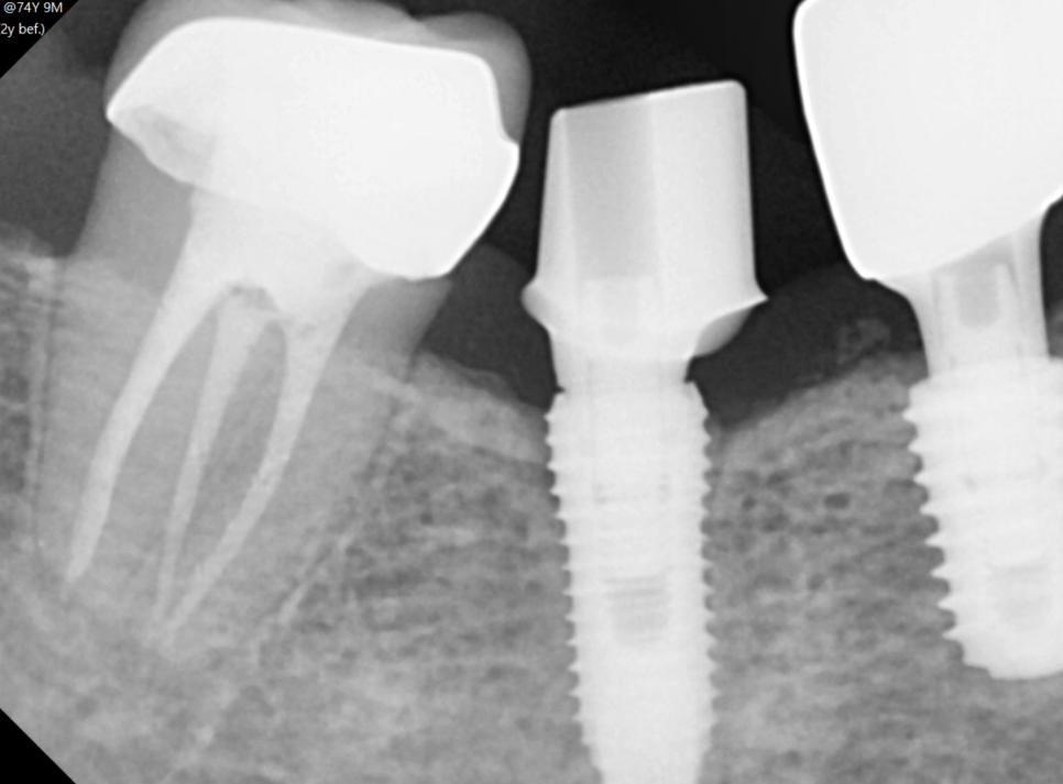 임플란트 사후관리 다른 병원 것도 수리 가능한 경우 정리해드립니다. 관련 이미지 3