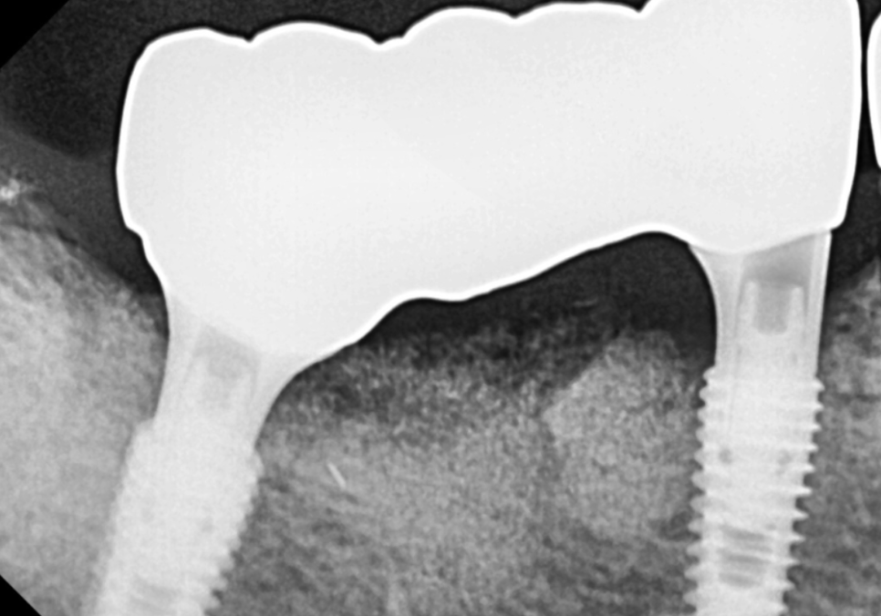 오래된 임플란트, 흔들림과 통증, 어떻게 하면 더 건강하게 쓸 수 있을까? 관련 이미지 13