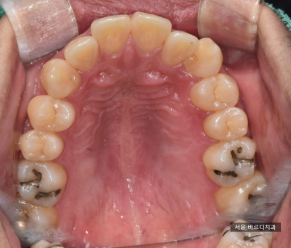 강남치과폐업 제발 호갱당하지마세요. 임플란트 병원 선택기준은? 관련 이미지 4