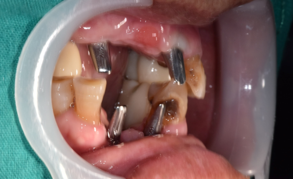 천호동 치과 자연 발치 후 방치된 치아 임플란트 케이스 관련 이미지 11