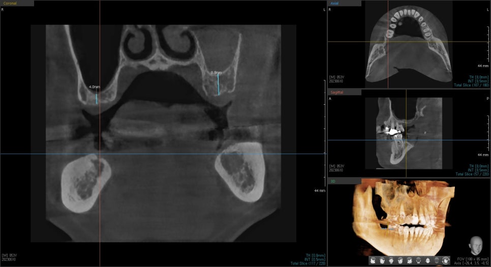 상일동치과 서울바르디치과 무절개 네비게이션 임플란트 치료증례 #7 관련 이미지 5