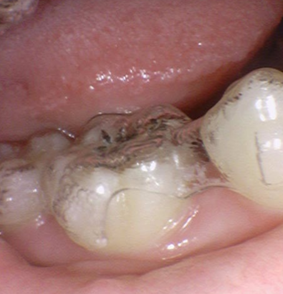 꼈다 뺐다 하는 교정 철사 붙이는건 옛말! 관련 이미지 6