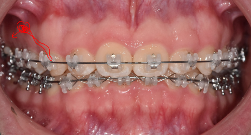 Answering Your Questions About Orthodontic Mini-Screw Placement. (Q&A) image 4