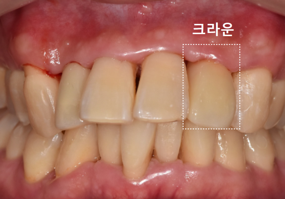 강동구 앞니 충치, 누구는 레진이고 누구는 임플란트인 관련 이미지 15