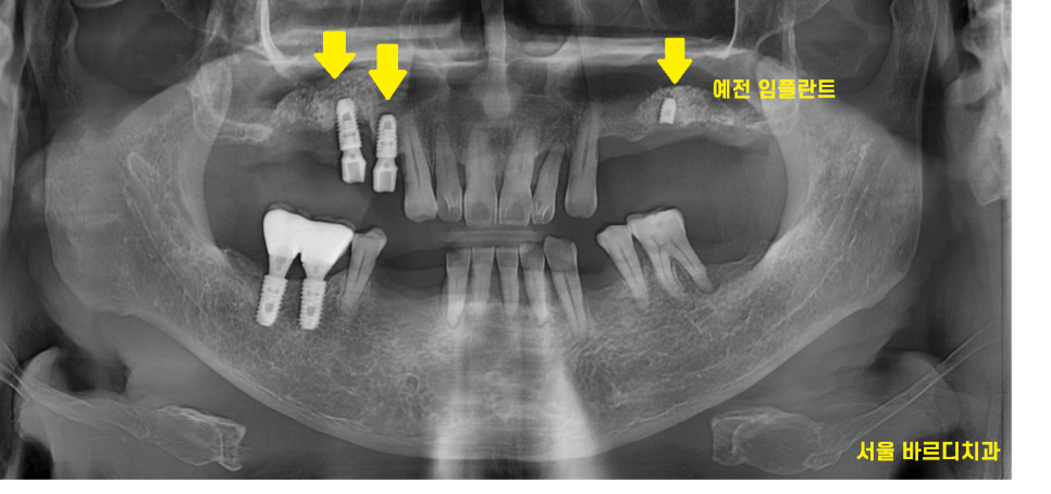 상일동역 근처 치과 타원 임플란트 제거 후 재식립 케이스 관련 이미지 2