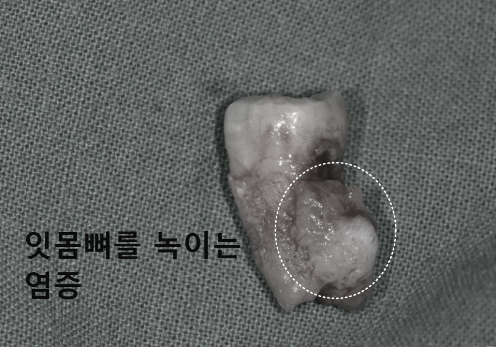 흔들리는 치아 묶어두는 잠간고정술, 오히려 잇몸뼈를 녹일 수도 있다고요? 관련 이미지 4