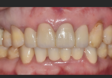 명일동 라미네이트 vs 크라운, 수명을 좌우하는 선택 기준 3가지 관련 이미지 13