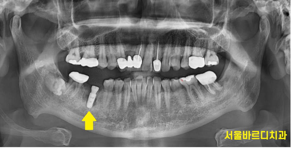 잇몸 물집 강일역 치과에서 원인 알아보고 임플란트로 치료했습니다. 관련 이미지 8