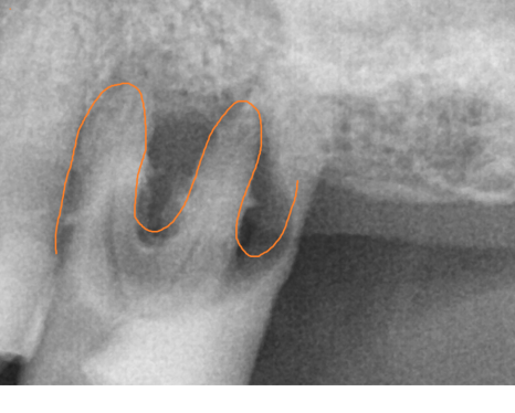외국인 치과 진료 하악 전체 임플란트 7개 심어 12개 치아 만들기 관련 이미지 4