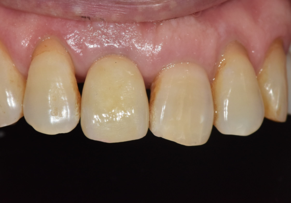 앞니 길어짐, 위 앞니가 점점 내려온다면? 관련 이미지 14