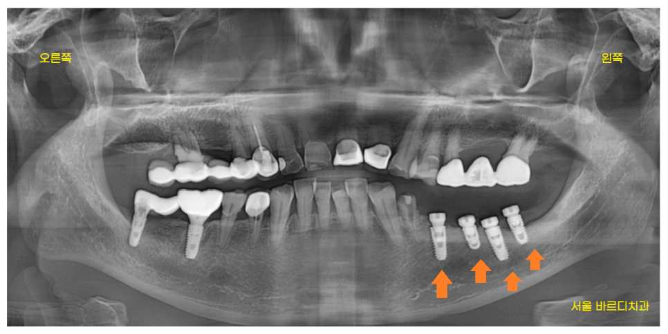 망월동 치과  양쪽 어금니 문제가 있을때 치료 순서는? 관련 이미지 6