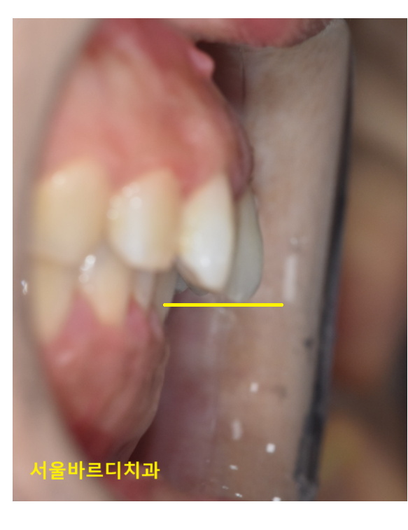 아랫니가 안보여요 과개교합 원인, 문제점 알아보아요! 관련 이미지 3