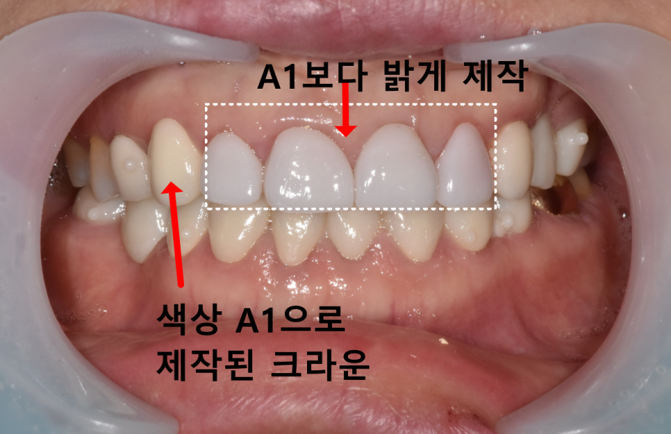 누런 치아 연예인치아 처럼 하얗게 만들 수 있나요? 관련 이미지 10