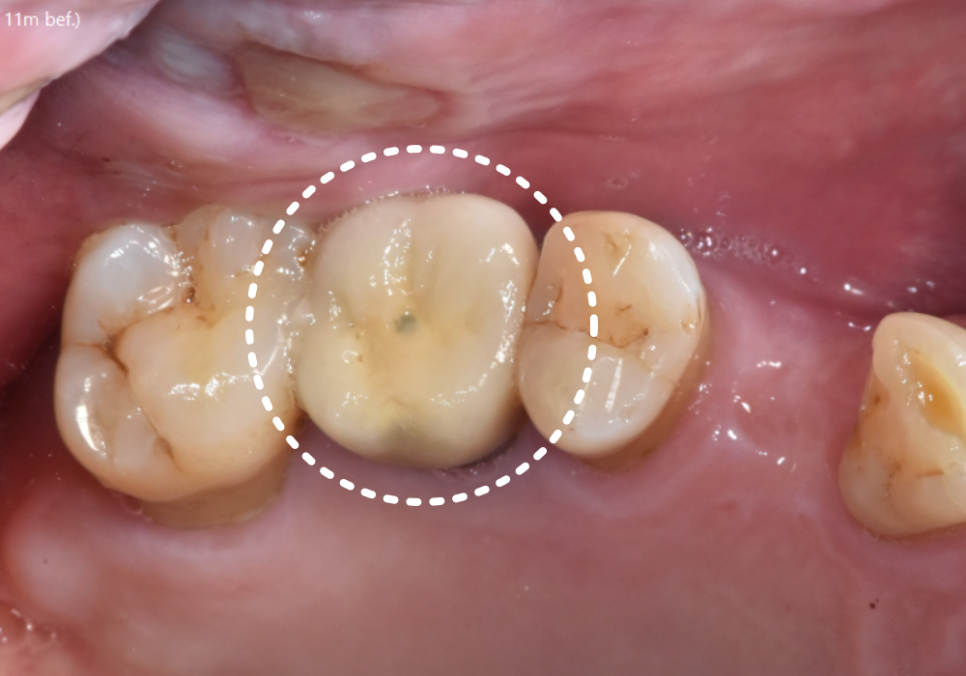 고덕 치과, 임플란트가 흔들려요. 뽑아야 할까 봐 고민이라면? 이렇게 해결합니다. 관련 이미지 5