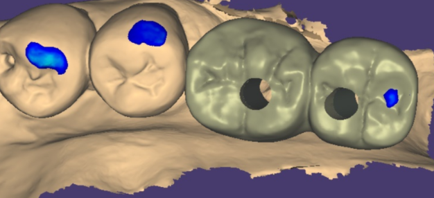 길동 치과 임플란트 2차 수술이요? 예전에 했잖아요 관련 이미지 7