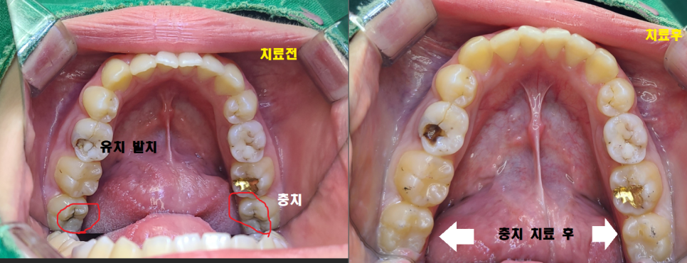 충치치료 레진 비용 이 금액이 맞나 궁금하신 분들을 위하여 관련 이미지 3