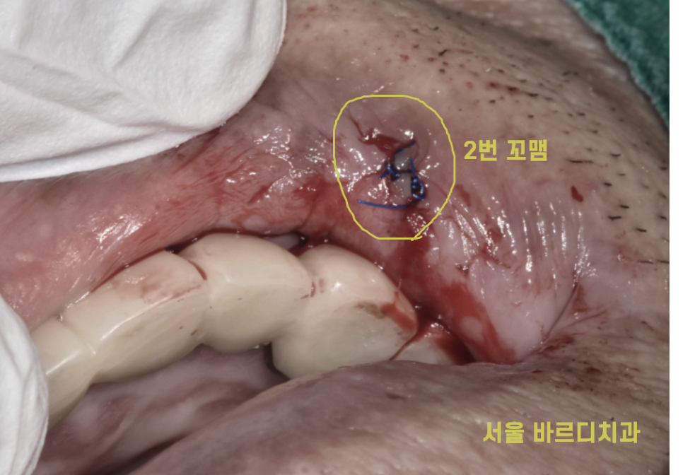 입술 혹 씹었을때 부풀고 딱딱 하다면 간단히 제거하세요 관련 이미지 6
