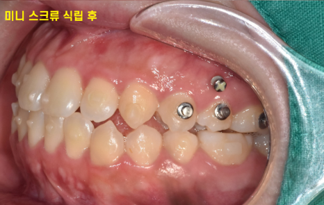 교정중 미니스크류 필수일까? 투명교정도 때로는 필요하다 관련 이미지 5