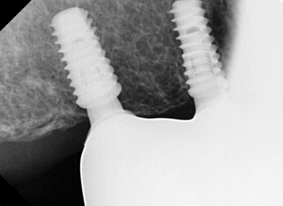 오늘 임플란트 심고, 내일 씹는게 가능하다고요?? (잔존골은 정답을 알고있다) 관련 이미지 6