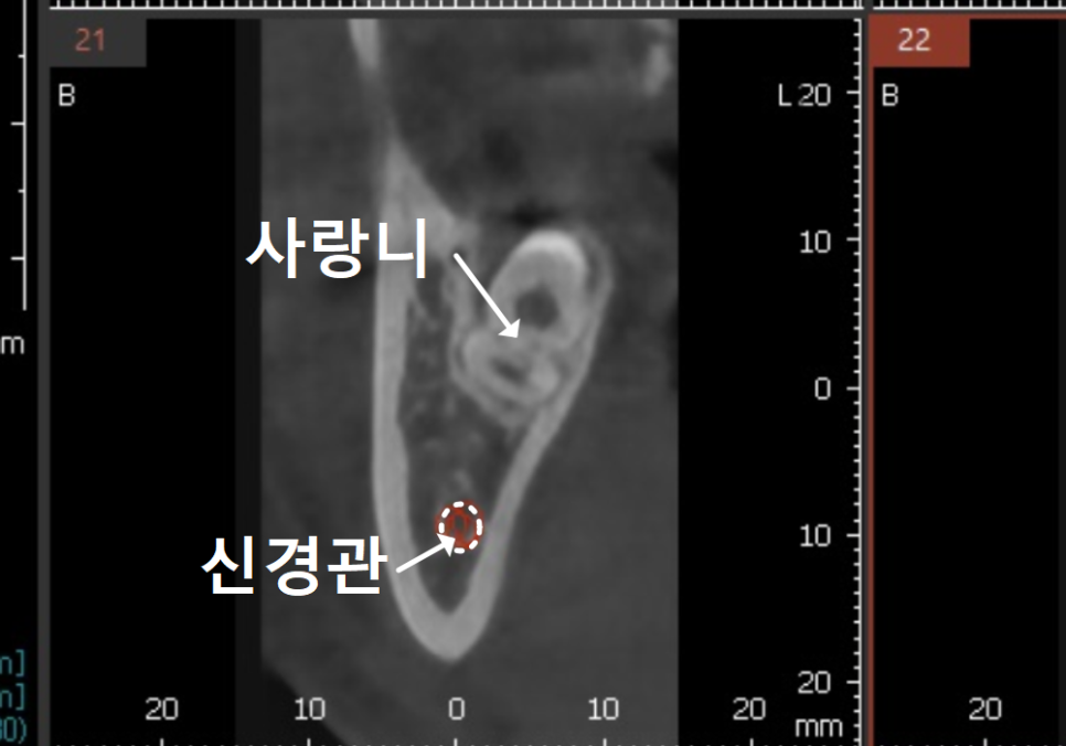 고덕동 사랑니 매복 발치, 안 아픈데 꼭 빼야 하나요? 관련 이미지 4