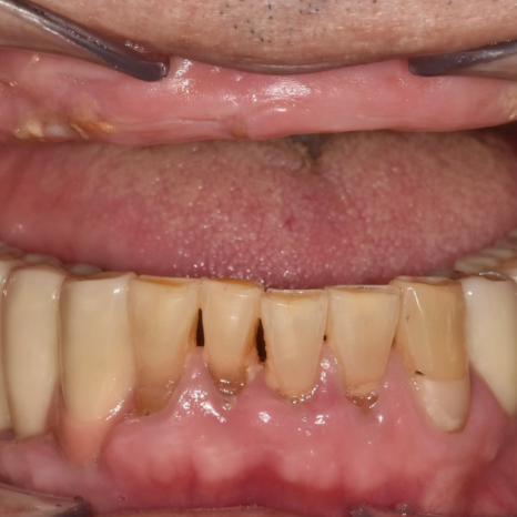 Gangdong-gu Dental Clinic: Are There Cases Where Implants Are Impossible? image 1