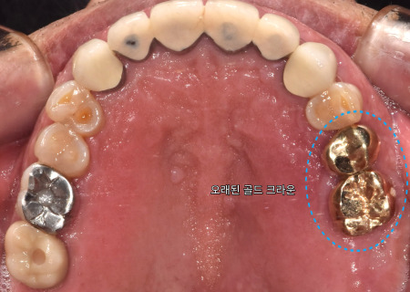 서울바르디치과 뿌리 끝 염증 심한 치아를 네비게이션 임플란트 #6 관련 이미지 1