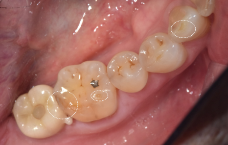 앞니 금 갔을 때, 방치하면 안 되는 진짜 이유 <파절 치료 사례> 관련 이미지 1
