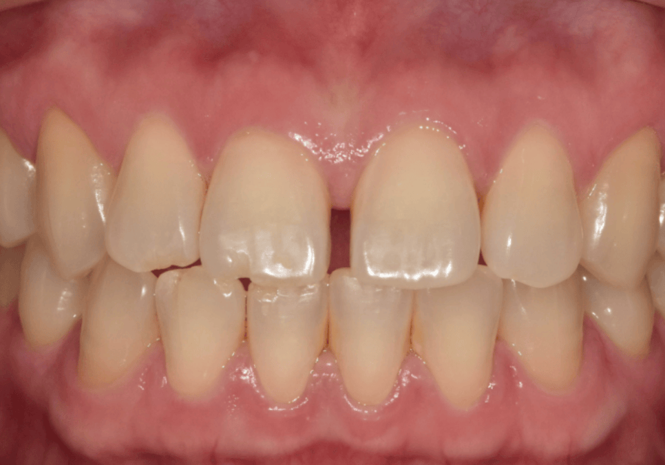 무삭제 라미네이트 적응증, 당신이 미처 몰랐던 시술의 조건을 공개합니다. 관련 이미지 7