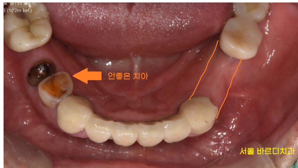 명일동 치과 임플란트 치료 기간 얼마나 걸릴까요??? 관련 이미지 4