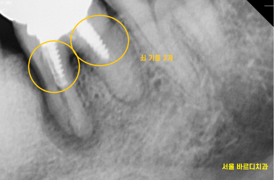 고덕역 치과 치아뿌리 파절 부러짐 있을 때 임플란트로 대체해야죠 관련 이미지 5