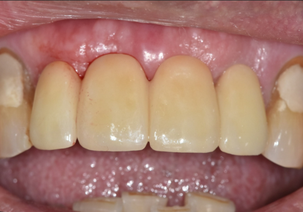 상일동역 치과 앞니 임플란트 기간 때문에 망설이신다면 꼭 보세요. 관련 이미지 12