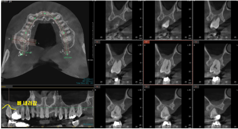 강동구 임플란트 뿌리 염증 심해질경우 대처 방법 관련 이미지 4