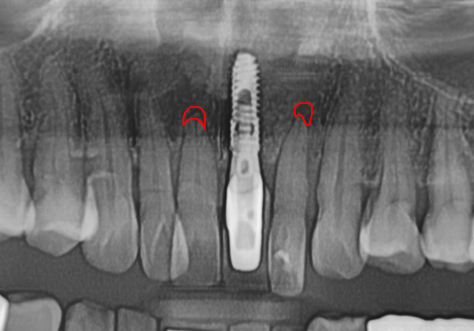 고덕동 임플란트, 튀어나온 앞니, 비용은 줄이고 자연스럽게 개선한 실제 사례 관련 이미지 6