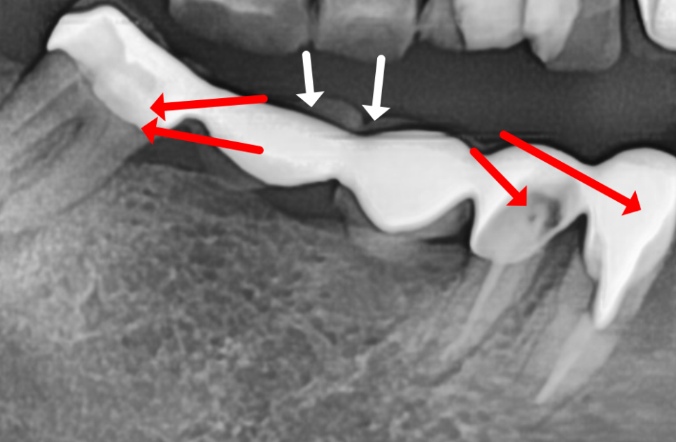 오래된 어금니 롱브릿지, 교체 타이밍을 놓치면 관련 이미지 3