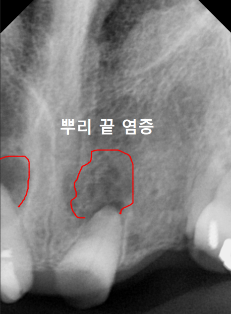 뿌리만 남은 치아, 그대로 두면 왜 위험할까요? 고덕동 전체 임플란트 재건 사례 관련 이미지 5