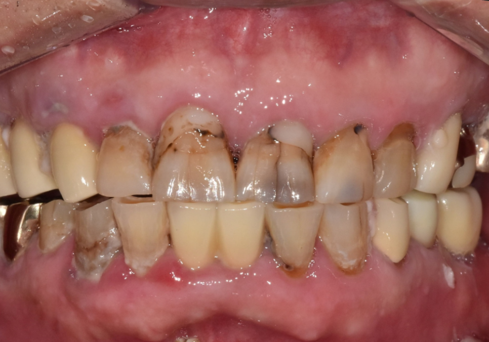 앞니 음식물 끼임, 왜 젊을 때보다 더 자주 발생하는 걸까요? 까맣게 변한 앞니 치료 사례 관련 이미지 1