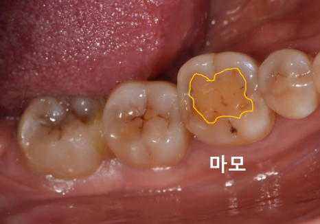 대문니 파절, 앞니에 금이 쩍 갈라졌다면? 딱딱한 음식을 조심해야 하는 이유 관련 이미지 7
