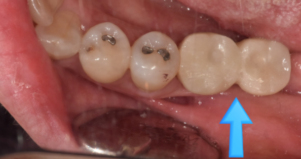 길동 치과 임플란트 2차 수술이요? 예전에 했잖아요 관련 이미지 8