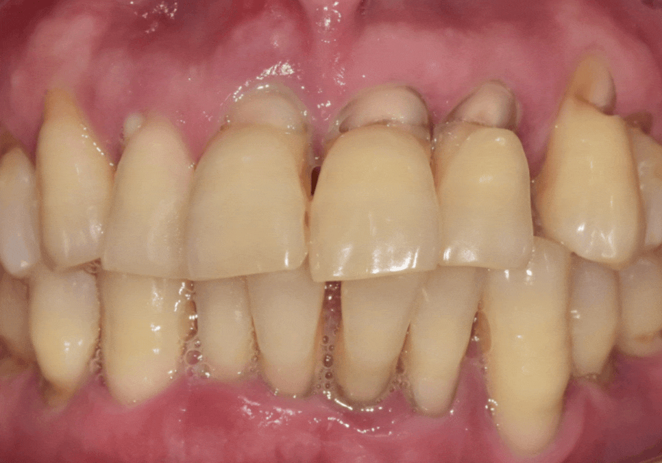 치아 시림 증상 때문에 고민이신가요? 그렇다면 양치질 너무 열심히 하지 마세요. 관련 이미지 13