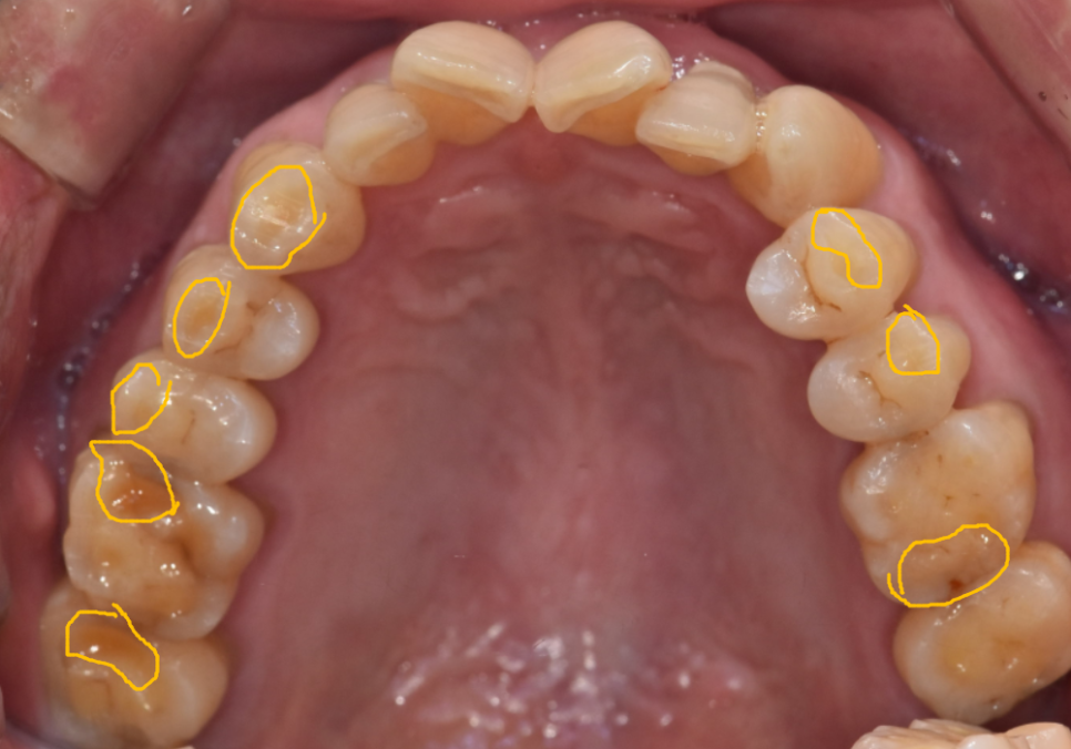 어금니 금 감, 치아 살릴 수 있는 기준은 바로 관련 이미지 5